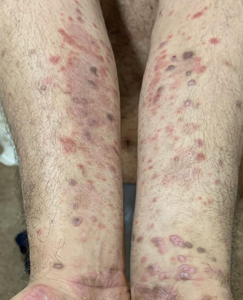 My arms and hands in 2018 covered by the same rash.