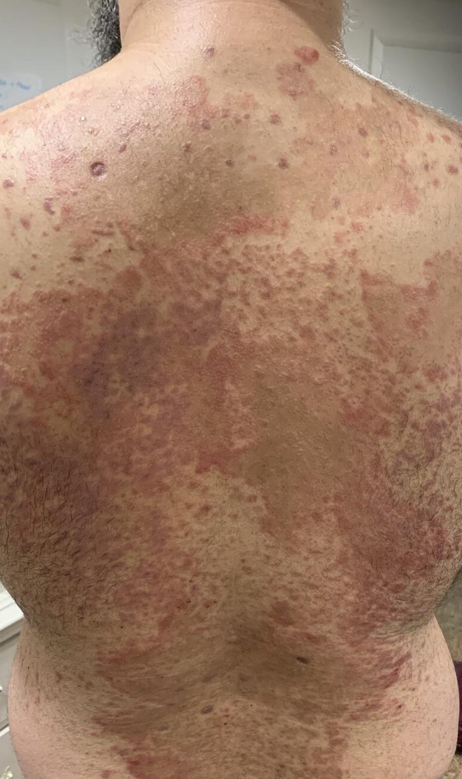 My back in 2018 during a severe full-body rash that resisted every treatment.